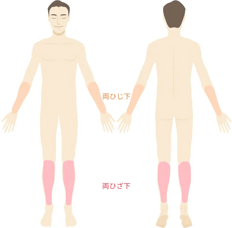 両ひじ下・両ひざ下脱毛 施術パーツ